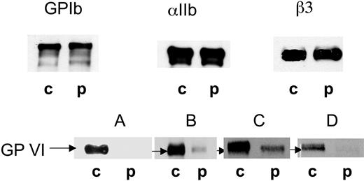 Figure 5. Western blotting of platelet receptors confirmed a GPVI deficiency. SDS-soluble extracts of platelets from the patient (p) and a control donor (c) were separated by SDS-PAGE without disulfide reduction and transferred to nitrocellulose membrane. The membranes were probed for GPIb (Bx-1), αIIb (SZ22), β3 (XIIF9), and GPVI using the MoAbs F5 (A,B), 3J24.2 (C), and 9E18.2 (D). Bound antibody was located using a chemiluminescence procedure. GPIb, αIIb, and β3 were assessed using 10 μg protein, while GPVI was analyzed using 10 μg (A) and 20 μg (B-D) protein.