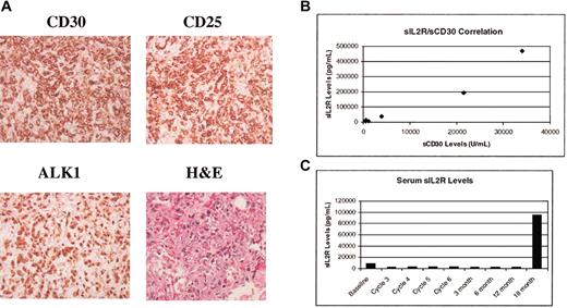 Figure 1. Tissue stains and levels of serum sCD30 and sIL-2R. (A) Immunohistochemical staining of tumor tissue for CD30, CD25, ALK1, and hematoxylin and eosin stain of tissue. Images were viewed under an Olympus BX41 microscope equipped with UPlan F1 40 ×/0.75 objective lenses and an Olympus DP12 digital camera (Olympus, Melville, NY). Images were imported with an Olympus Camedia USB Smartmedia card reader into Adobe Photoshop 7.0 (Adobe, San Jose, CA) for processing. (B) Correlation of serum sCD30 and sIL-2R levels in patients with ALCL. Correlation coefficient r = 0.97. (C) Serum sIL-2R levels during therapy with EPOCH infusional chemotherapy. The elevated levels seen before therapy normalized within one cycle of treatment.