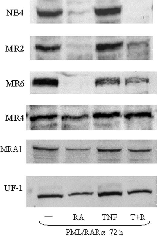 Figure 2. Expression of PML/RARα in RA-resistant APL cells. Western blotting showing expression of PML/RAR in RA-resistant APL cells. Nuclear extracts (50 μg) were used for each analysis. Results show that TNF did not augment the degradation of PML/RARα in response to RA.