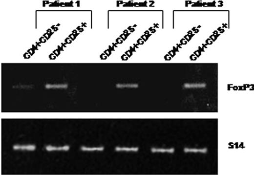 Figure 2. CD4+CD25+ T cells isolated from HIV-infected patients constitutively express Foxp3 mRNAs. RNA was extracted from purified CD4+CD25– (lanes 1) and CD4+CD25+ (lanes 2) T cells immediately after cell isolation from 3 patients. Foxp3 expression was analyzed using 2 steps of RT-PCR (see “Analysis of TGF-β1 and FoxP3 expression”). An expected 152-bp PCR product was detectable in CD4+CD25+ but not in CD4+CD25– T cells (except a faint detectable band in patient 1).