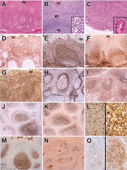 Figure 1. The histology and immunophenotype of MZ and IEBCs of the cases. Panels A, B, and D-M show the tonsil biopsy of case 2. Panel C shows the appendectal biopsy of case 5. Panels N and O show the tonsil biopsy of case 4. (A) Hematoxylin and eosin-stained sections of tonsil in case 2. There is widening of the MZs around hyperplastic follicles. (B) Higher magnification of MZ, adjacent crypt epithelium (Ep), mantle zone, and follicle center (FC). Inset shows cytologic detail of the MZ cells with transformed blasts. (C) Hematoxylin and eosin-stained sections of the appendix in case 5 showing broadening of the MZs around hyperplastic B-cell follicles. The inset shows a crypt infiltrated by MZ lymphocytes. (D-F) The MZ and intraepithelial lymphocytes express IRTA-1 (D) and CD 43 (E) but fail to express CD27 (F). (G) The proliferation fraction shown by Ki 67 immunostaining is high. (H-I) The MZ cells show weak expression of IgD (H) and strong expression of IgM (I). (J-L) In contrast to the germinal center and follicular mantle, the MZ cells do not express Igκ light chain (J) but do show strong expression of Igλ light chain (K). (L) High magnification of MZ cells immunostained for κ light chain (left) and λ light chain (right). There is striking λ light-chain restriction. Scattered small lymphocytes (probably residual mantle zone cells) express κ light chain. (M-O) The follicle center cells in the tonsil biopsy of case 2 express CD10 (M), but in case 4 where the follicles are colonized by MZ cells, the CD10+ follicle centers are fragmented (N). (O) The colonized areas of the follicles do not express κ light chain (left) but show uniform expression of λ light chain (right). Original magnifications, × 40 (A,C); × 200 (B,O); × 1000 (B inset); × 400 (C inset, L); and × 100 (D-K, M-N). Microscope, Olympus BX51; numerical aperture of objective lenses used: × 4, 0.16 mm (A-C); × 10, 0.40 mm (D-K, M-N); × 20, 0.70 mm (B,O); × 40, 0.85 mm (C inset, L); and × 100, 0.95 mm (B inset). Stains used: hematoxylin and eosin (A) and immunoperoxide (B-D). Camera, Olympus DP11 (Olympus, Tokyo, Japan); acquisition software, Adobe Reader 6.0 (Adobe, San Jose, CA); and software used for image processing, Adobe Photoshop 5.0.