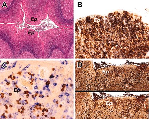 Figure 2. The histology and immunophenotypic characteristics of intraepithelial B cells in a control tonsil. (A) Control tonsil showing reactive follicular hyperplasia with no expansion of the MZ. The crypt epithelium (Ep) contains numerous intraepithelial lymphocytes. (B) CD27 immunostaining highlights expression by the intraepithelial B cells. (C) Double immunostaining for CD3 in brown (DAB) and CD43 in blue (fast blue) shows many individual blue cells expressing CD43, but not CD3, consistent with intraepithelial B cells. (D) Crypt epithelium stained for κ immunoglobulin light chain (top) and λ light chain (bottom). The intraepithelial B cells are polytypic. Original magnifications, × 40 (A); × 200 (B); × 400 (C); and × 100 (D). Microscope, Olympus BX51; numerical aperture of objective lenses used: × 4, 0.16 mm (A); × 10, 0.40 mm (D); × 20, 0.70 mm (B); × 40, 0.85 mm (C). Stains used: hematoxylin and eosin (A) and immunoperoxide (B-D). Camera, Olympus DP11; acquisition software, Adobe Reader 6.0; and software used for image processing, Adobe Photoshop 5.0.