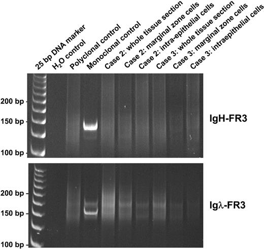 Figure 3. Analysis of PCR products of FR3 regions of IgH and Igλ genes on polyacrylamide gels, in whole sections, and microdissected tissues of cases 2 and 3. PCR indicates polymerase chain reaction; FR3, framework 3 region; IgH, immunoglobulin heavy chain; and Igλ, immunoglobulin lambda light chain.