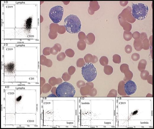 Figure 2. Typical morphology of Burkitt leukemia. Characteristic immunophenotype is illustrated by flow cytometric analysis: CD10+, CD19+, CD20+ (bright), surface immunoglobulin light chain λ restricted (bright) and CD5–. Peripheral blood involvement by BL (H&E stain) was photographed using the Olympus model BX50 microscope (Olympus UPlanF1 100X/1.30 oil). Photography was performed with the digital camera MTI model 3CCD, PAXit version 2.0 software, and Adobe Photoshop 7.0 imaging processing. For the flow cytometry inserts, data was acquired using a Coulter FC500 instrument (Beckman-Coulter, Fullerton, CA) with XCP version 1.2 analysis software (Beckman-Coulter).