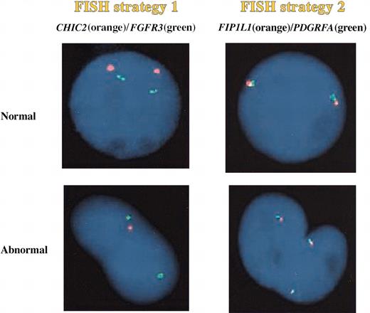 Figure 2. Interphase FISH. Deletion of 1 of the CHIC2 alleles results in 1 orange and 2 green signals in interphase nuclei (FISH strategy 1). However, this 2-color FISH strategy using CHIC2/FGFR3 probe set would appear normal if CHIC2 was translocated rather than deleted. In such cases, the abnormality will be detected by the second FISH strategy where the insertional translocation involving excision of the CHIC2 locus results in a FISH signal pattern of 3 fusions using the FIP1L1/PDGFRA probe set.