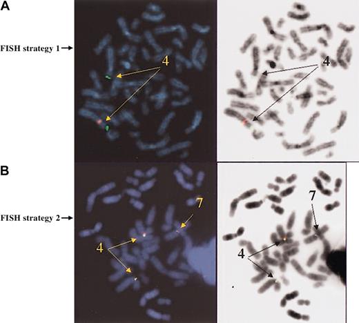 Figure 3. Metaphase FISH. Signal patterns of abnormal results from either deletion (A) or translocation (B) of CHIC2 by metaphase FISH. In both panels, 7 indicates chromosome 7; 4, chromosome 4.