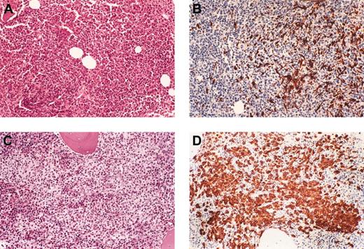 Figure 4. Differences in the histologic pattern of bone marrow mast cell infiltration in SMCD-eos patients with and without FIP1L1-PDGFRA fusion. Hematoxylin-eosin (H&E)–stained (A,C) and tryptase-immunostained (B,D) bone marrow biopsy tissue showing the ill-defined, loose aggregates of atypical mast cells associated with intense eosinophilia in cases with FIP1L1-PDGFRA fusion (A-B). Typical well-defined clusters of mast cells are rare and generally small (10-30 cells), and bone marrow mast cell infiltration may be difficult to recognize unless a tryptase immunostain is done for these patients. In contrast, patients without FIP1L1-PDGFRA fusion generally exhibit large, well-defined perivascular and/or peritrabecular clusters or diffuse infiltration of atypical mast cells associated with intense eosinophilia (C-D). Bone marrow mast cell infiltration is easily recognized on H&E-stained sections for these patients. Images were obtained using a Leitz Orthoplan microscope (Wetzlar, Germany) equipped with 160 ×/0.4 objective lenses (Leitz, Wetzlar, Germany).