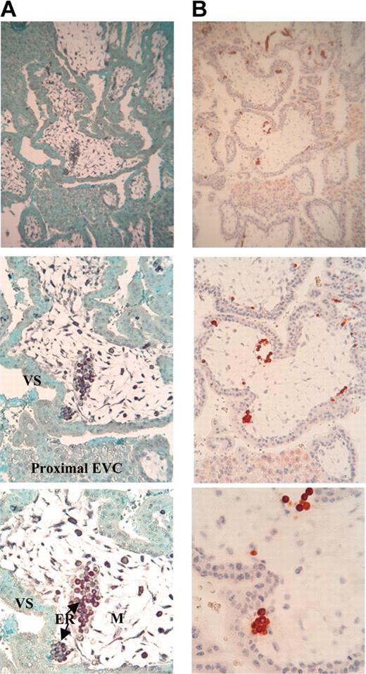 Figure 2. Colocalization of HLA-G mRNA and HLA-G protein in erythroid cells from first-trimester trophoblast. (A) Detection of either HLA-G mRNA (black) by in situ hybridization with DIG-labeled Pan HLA-G DNA probe or (B) HLA-G5/-G6 proteins (red) by immunohistochemistry by using the 5A6G7 mAb (right panel) on serial sections of first-trimester trophoblast (magnification from the top to the back of the photo: × 100, × 200, × 400). Sections were counterstained with Fast green and hematoxylin to visualize nuclei by in situ hybridization and immunohistochemistry analyses, respectively. EVC indicates extravillous cytotrophoblast; VS, villous syncytiotrophoblast; and M, mesenchymal core.
