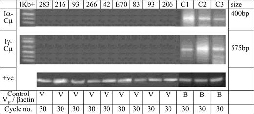 Figure 3. Analysis of switch circle transcripts in HCL expressing multiple sIg isotypes. Circle transcripts are a hallmark of active class switching deletional recombination, and these were analyzed in our series of HCL cases by an RT-PCR method as described previously.15 All HCL cases were found negative for both Iα-Cμ and Iγ-Cμ circle transcripts as shown. Template cDNA input was compared by using identical amounts of cDNA for amplification of VH as a reference gene (V). Assay conditions were validated by identifying CTs, confirmed by sequence analysis, in comparable amounts of cDNA from 3 control cases of CLL displaying unmutated VH genes (C1, C2, C3), which exhibit ongoing switching deletional events as reported.15 For CLL, β-actin was used as a loading marker gene (labeled B).