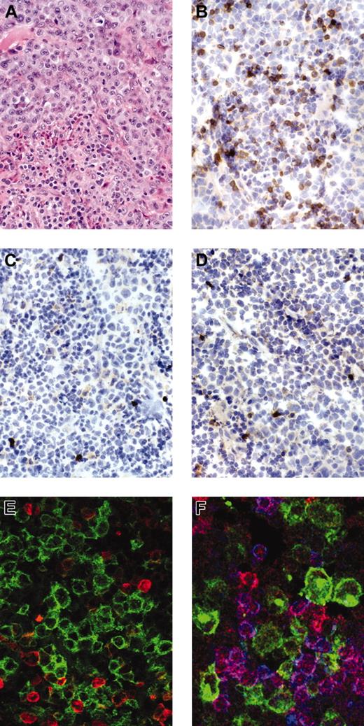 Figure 1. Staining for anaplastic large cell lymphoma. Anaplastic large cell lymphoma stained for H&E (hematoxylin and eosin; A), immunostains for βF1 (B), CD3 (C), and ZAP-70 (D) show negativity of the tumor cells with strong expression of the respective antigens in reactive small T cells. Immunofluorescent stains for (E) CD30 (green) and βF1 (red) (Zoom 2) or (F) CD30 (green), ZAP-70 (red), and CD3 (blue) confirm the negativity of CD30+ tumor cells for the respective antigens.