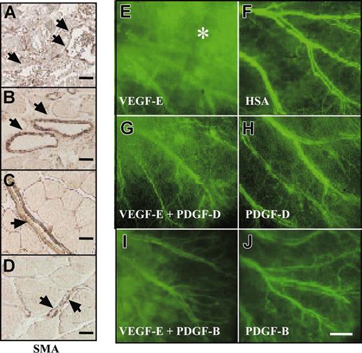 Figure 6. PDGF-D stabilizes VEGF-E–induced blood vessels. Staining for SMA in skeletal muscle injected with the indicated viral vectors. (A, arrowheads) Note the irregular SMC coating and enlarged vessels an AAV-VEGF-E–injected muscle. When injected with a combination of (B) AAV-VEGF-E and AAV-PDGF-D or (C) AAV-VEGF-E and AAV-PDGF-B, the vessels are still enlarged compared with (D) PBS-injected muscle, but the SMC coating is thick and regular (arrowheads; original magnification, ×100). FITC-dextran–injected mouse ears 1 minute after injection shown for mice injected with the indicated AAV vectors. (E, asterisk) Note that AAV-VEGF-E–induced angiogenic vessels leak the FITC-dextran, but a large part of this leak is halted when AAV-VEGF-E is combined with AAV-PDGF-D or PDGF-B (G, I). Comparison with (H) AAV-PDGF-D, (J) AAV-PDGF-B, and (F) AAV-HSA (original magnification, ×20). Bars represent 250 μm (J) and 20 μm (A-D).