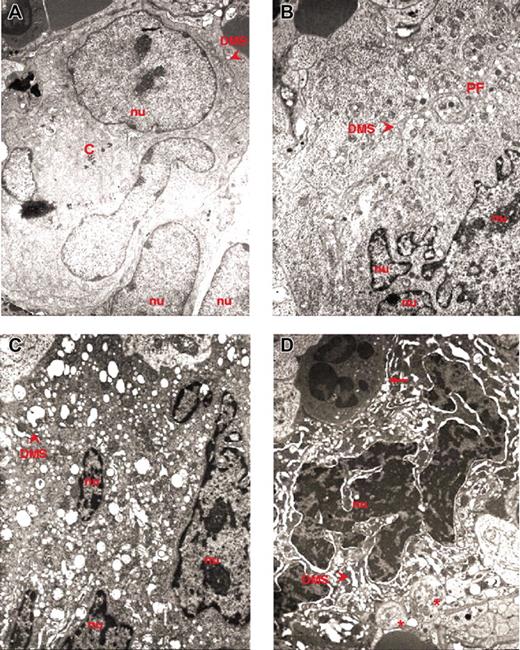 Figure 2. Ultrastructural electron density and heterogeneity of MKs from the spleen of GATA-1low mice. TEM of representative MKs identified in spleen sections from GATA-1low mice. Light and heavy electron-dense MKs are presented in panels A-B and C-D, respectively; nu indicates nuclear area; arrowhead, DMS; C, centrioles; PF, platelet field; arrows, neutrophils; asterisks, platelets. Original magnification × 3000 for all panels.
