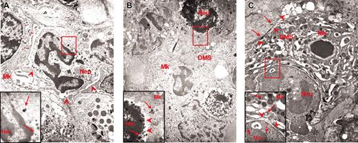 Figure 7. Immunogold labeling for myeloperoxidase of neutrophils at different stages of their emperipolesis within GATA-1low MKs. Examples of neutrophils approaching the MK (A), penetrating the MK through the DMS (B), and embedded in the MK cytoplasm (C). The rectangle in each panel indicates the area shown at higher magnification in the insert. The arrows indicate isolated as well as clustered gold particles. The arrowheads in the panels indicate the extracellular membrane of the MK; those in the inserts, the neutrophil/MK border. Immunogold particles are localized only in the neutrophil in panel A, on both sides of the neutrophil-MK border in panel B, and on both sides of the neutrophil/MK border and on the extracellular side of the MK membrane in panel C. Original magnification × 3000 for all panels and × 30 000 for the inserts.