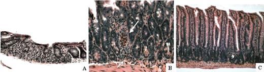 Figure 4. Histopathologic evidence of acute GVHD after donor TBM, but not FC, transplantation. Small intestines were harvested from HSC+TBM and HSC+FC recipients on day 28. Paraffin-embedded sections were stained with H&E and were histologically analyzed for evidence of GVHD. (A) Small intestine of a representative HSC+TBM recipient (n = 7) exhibits villous shortening, crypt dropout, and extensive lymphocytic infiltration of the lamina propria (original magnification, × 200). (B) In these same mice, lymphocytic infiltration of crypts with apoptosis (open arrow) and the formation of a crypt abscess (closed arrow) is observed at higher magnification (original magnification, × 400). These findings are indicative of moderate to severe GVHD. (C) Small intestine of a representative HSC+FC recipient (n = 7). There is no evidence of GVHD (original magnification, × 200).