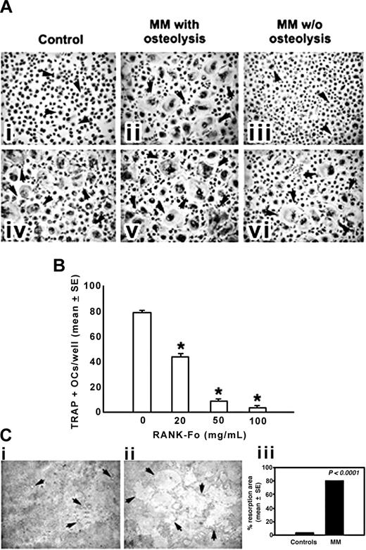 Figure 1. OCs generated from human MM PBMCs. (A) OCs were obtained from unfractionated PBMCs of patients with MM with or without osteolysis (ii,iii,v,vi) and controls (i,iv). Numerous and large-sized OCs (arrows) developed in the unstimulated cultures from patients with MM with osteolysis (ii), whereas rare and small-sized OCs were observed in the cultures from patients with MM without osteolysis (iii) and controls (i). No significant increase in OC formation was observed in MM PBMCs from the patients with osteolysis by exogenous M-CSF and RANKL (v), whereas these cytokines were essential to triggering the OC formation in patients with MM without osteolysis (vi) and controls (iv). Multinucleated (> 3 nuclei per cell) and TRAP+ cells were identified as OCs. The arrows point to the OCs (magnification, × 200). (B) The inhibition of RANKL by RANK-Fc prevented in a dose-dependent manner the OC formation in unstimulated and unfractionated PBMC cultures from patients with MM. *P < .001. (C) Photomicrographs of the pits formed on Millennium Osteologic slides by the OCs. Numerous and large resorption areas (arrows) were observed in the MM bone disease samples (ii) with respect to the few and small pits detected in the controls (i). The percentage of mineral surface resorbed by the OCs was quantified with an image analyzer. The data reported in the graph correspond to the mean ± SE (iii). See “Cell cultures” for figure acquisition info.
