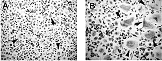 Figure 2. T cells mediate osteoclastogenesis in human MM PBMCs. Osteoclastogenesis occurred in T-cell–depleted MM PBMCs cultured in the absence (A) or in the presence (B) of M-CSF and RANKL. Small-sized OCs developed in the absence of M-CSF and RANKL (A), whereas exogenous cytokines triggered the formation of large-sized OCs (B). Multinucleated and TRAP+ cells were identified as OCs. The arrows point to the OCs (magnification × 200).