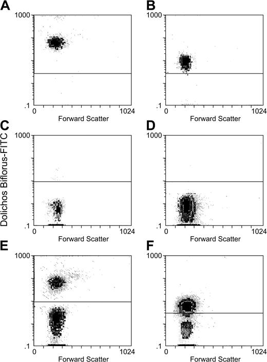 Figure 1. Group O and A1 RBCs can be clearly distinguished by Dolichos biflorus–FITC staining and flow cytometry. A sample of washed group A1 blood from patient 1 (A) was mixed with washed group O blood from donor 1 (C) in a ratio of 1:3 (patient 1 and donor 1 blood mixture is seen in panel E). A sample of patient 2 group A1 blood (B) was mixed with donor 2 group O blood (D) in a 1:1 ratio (mixture of patient group A1 blood and donor 2 group O blood is seen in panel F). All were stained with Dolichos biflorus–FITC and analyzed by flow cytometry. Above are scattergrams (E-F) showing that samples of the 2 blood groups can be clearly discriminated by flow cytometry.