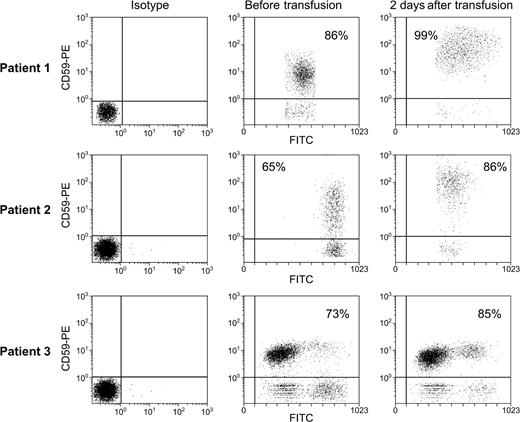 Figure 3. CD59 is transferred to patient granulocytes following transfusion. To exclude hemolysis as an explanation for the RBC results, we examined transfer of a GPI–anchored protein, CD59, to granulocytes. Whole blood was diluted as described in “Patients, materials, and methods” and stained with FITC-conjugated CD15-specific mAb and PE-CD59-specific mAb. Gates were drawn to include only cells staining with FITC (cells of group A1 blood). Above are scattergrams showing staining of patient granulocytes with PE-conjugated antibody to CD59.