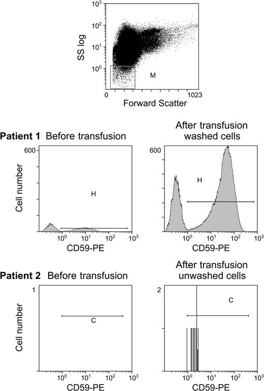 Figure 4. RBC microvesicles increase following transfusion in patients receiving washed RBCs. Our previous data demonstrated that transfer from RBC microvesicles was much more effective than cell-to-cell transfer. We examined the number of circulating RBC microvesicles in healthy controls and following transfusion of washed and unwashed RBCs. Gating was performed to include a microvesicle population that was smaller than erythrocytes and staining with antiglycophorin (top panel). Although the number of RBC microvesicles increased following unwashed RBCs (patient 2), there was a marked increase following transfusion of washed RBCs (patient 1) where the number of microvesicles increased from 10 microvesicles/μL to 1000 microvesicles/μL.