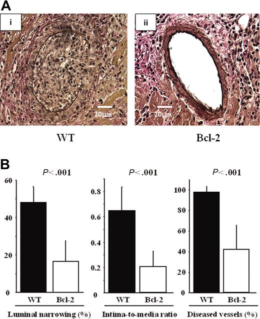 Figure 6. Reduction of GCAD by Bcl-2 overexpression 30 days after transplantation. Representative sections of cardiac allografts stained with elastic van Gieson for evaluation of GCAD in the (Ai) WT donor heart group and (Aii) the Bcl-2 Tg donor heart group. (Ai) Note that marked fibrointimal thickening and luminal narrowing, morphologically resembling typical human GCAD, are observed in the WT donor heart group. (Aii) In contrast, decreased intimal thickening and preserved vessel lumen are observed in the Bcl-2 Tg donor heart group. A Leica DMRB fluorescent microscope (Leica Microsystems, Frankfurt, Germany) and SPOT Advanced Version 3.4.2 software (Diagnostic Instruments, Sterling Heights, MI) were used. Original magnification, × 400. (B) Morphometric assessment of cardiac grafts. Note that compared with parameters in the WT donor heart group, all 3 GCAD parameters are significantly lower in the Bcl-2 Tg donor heart group 30 days after transplantation. ▪ indicates the data from WT heart grafts (n = 8); □, those from the Bcl-2 Tg heart grafts (n = 8). Mean ± SD values are shown.