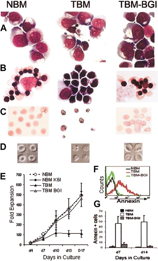 Figure 2. Effective erythropoiesis from vector-transduced human thalassemia major bone marrow CD34+ cells in vitro. Wright-Giemsa–stained cytospins of predominant cell types in erythroid cultures. (A) Cells are mainly pronormoblasts in NBM, TBM, and TBM-BGI at day 4, (B) orthochromic normoblasts in NBM and TBM-BGI, but polychromatophilic normoblasts in TBM, at day 13. (C) Enucleated RBCs produced in NBM and TBM-BGI at day 17, while TBM shows apoptotic cells. (D) Differential interference contrast microscopy of Hoechst 33342–negative cells (enucleated RBCs) sorted by FACS showing normal reticulocyte and discocyte morphology of NBM and TBM-BGI RBC. Occasional RBCs derived from TBM were dysmorphic. (E) Fold expansion of erythroid cultures derived from CD34+ cells (n = 4): mock-transduced NBM (⋄), K6I-transduced NBM (▪), mock-transduced TBM (▴), and BGI-transduced TBM (▵). The mean fold expansion at day 13 was NBM 356 ± 22, NBM K6I 360 ± 101, TBM 110 ± 31, TBM-BGI 308 ± 28; and at day 17 was NBM 494 ± 36, NBM K6I 498 ± 119, TBM 108 ± 36, TBM-BGI 458 ± 78 (P < .001 and P < .002 for NBM versus TBM and P = .1 and P = .3 for NBM versus TBM-BGI, at day 13 and day 17, respectively). (F) Representative apoptosis analysis using annexin-V labeling of NBM, TBM, and TBM-BGI erythroid cultures. (G) Quantification of apoptotic (annexin-V+) cells at day 7 and day 14 from the 4 experiments. NBM (filled bars), TBM (open bars), and TBM-BGI (hatched bars). Day 7: P < .01 NBM versus TBM; P < .08 NBM versus TBM-BGI; day 14: P < .004 NBM versus TBM; P < .1 NBM versus TBM-BGI.