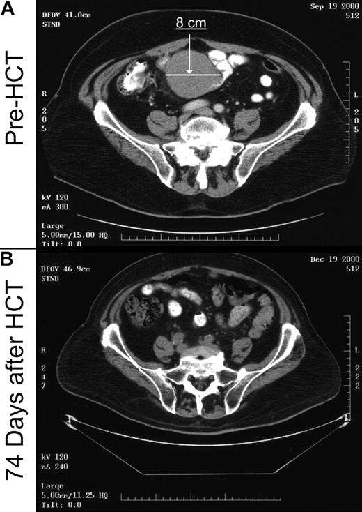 Figure 2. Example of graft-versus-tumor response. Patient no. 20, as shown in Table 1, was a 69-year-old man with rapidly progressive mantle cell NHL. Prior treatments included 8 lines of chemotherapy with only a 6-month remission to high-dose radiolabeled antibodies with autologous peripheral blood stem cell support. At the time of transplantation, he had kinetically failed Etoposide, Methylprednisolone, Ara-C Cisplatin (ESHAP), with rapidly progressive disease during the pretransplantation workup. (A) Pretransplantation computed tomography (CT) scan image (day –27) through the upper pelvis demonstrating an 8-cm by 7-cm mass that extended through twelve 0.5-cm cuts. (B) CT scan image through the same region demonstrating complete resolution of the mass on day +74 after nonmyeloablative transplantation from a matched unrelated donor. The patient remains in remission 30 months after transplantation with no evidence of GVHD.