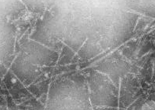 Electron micrograph of AL fibrils extracted from the spleen of a patient. (Walsh MT and Gantz D, unpublished image, March 31, 2003; used with permission from Dr Gantz.)