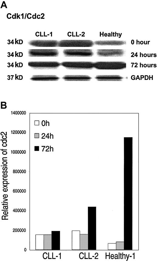 Figure 6. Western blot analysis. (A)Western blot analysis of cdc2 in CLL cells from 2 patients and from healthy B cells at time 0, and at 24 and 72 hours after CD40 activation. (B) Levels of expression corrected for protein loading.