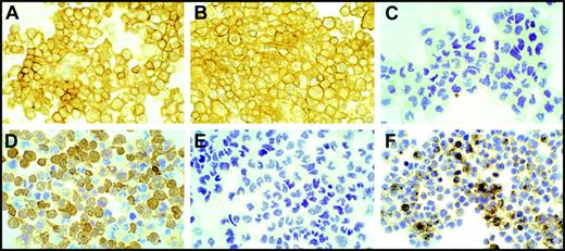 Figure 3. Characterization of human PBMCs immortalized by infection of M fermentans. Human PBMCs (K4420-Mi) that continued to proliferate for more than 5 months after infection with M fermentans (Mi) were centrifuged onto slides by cytospin for immunocytochemistry study. Practically, all cells show intensely positive staining for LCA (A) and antigen L26 (CD20, B) and negative staining for CD3 marker (C). Cells are found positive for monotypic immunostaining for lambda light chain (D) and positive for EBV latent membrane protein (LMP1, F). These cells were negative for kappa light chain staining (E). Images were captured on an Olympus BH-2 microscope (Olympus) equipped with an Olympus 35-mm film camera PM-C35DX. Original magnification was × 200 under a Splan apochromatic objective lens, numerical aperture 0.46.