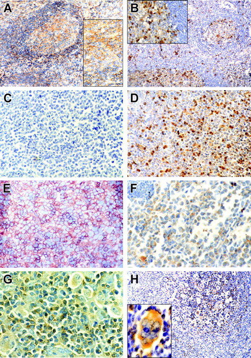 Figure 5. CD150 and SH2D1A expression in reactive tonsils and primary lymphoma cells. Immunohistochemical staining of CD150 (left panels: A, C, E, G) and SH2D1A (right panels: B, D, F, H,) on reactive tonsils (A, B), lymph node sections from patients with GC-DLBCL (C, D), ABC-DLBCL (E, F), and HD (G, H). CD150 and SH2D1A were coexpressed in malignant cells in ABC-DLBCL and HD. Original magnifications: 100 × (A, B, H), 400 × (C-F, and insets in A and B), 1000 × (G and H inset). H inset was magnified with Photoshop software (Adobe Systems, San Jose, CA). DAB staining shows specific reactions in brown.