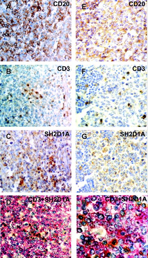 Figure 6. CD20, CD3, and SH2D1A expression on serial sections of DLBCL. Immunohistochemical staining of CD20 (A, E), CD3 (B, F), and SH2D1A (C, G) on paraffin-embedded sections. DAB staining shows specific reactions in brown. (D, H) Double-staining of CD3 (DAB substrate in brown) and SH2D1A (Fast Red substrate in red). GC-DLBCL (A-D) and ABC-DLBCL (E-H). Original magnifications: 400 × (A-G), 1000 × (H).