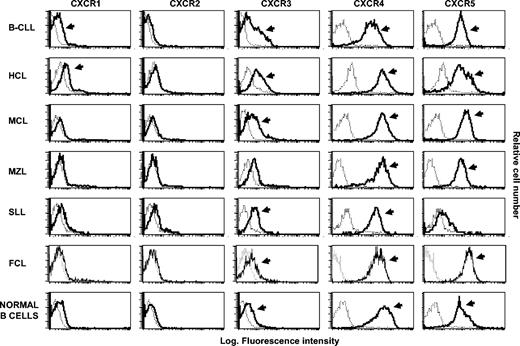 Figure 2. Flow cytometry analysis of CXCR shows distinct pattern of expression of these receptors among different B-NHLs. The histograms were obtained from a representative healthy subject and from malignant B lymphocytes recovered from representative patients with different types of NHL. The analysis was performed by flow cytometry on purified B lymphocytes following incubation with anti-CXCR receptor mAbs (bold histograms) and control isotype mAbs (dotted histograms). Arrows denote positive cases on the basis of Kolmogorov-Smirnov test.