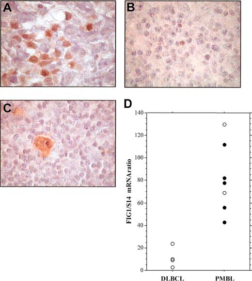 Figure 4. Immunohistochemical detection of phosphorylated STAT6 protein in specimens of PMBL, DLBCL, and cHL. (A) Staining for nuclear P-STAT6 was demonstrated in neoplastic cells of PMBL. (B) In nonmediastinal DLBCL, neoplastic cells were negative for P-STAT6 with only a few scattered reactive cells being positive. (C) HRS cells of cHL disclosed strong staining for P-STAT6. (D) Quantitative RT-PCR analysis of FIG1/IL4I1 gene expression in 4 DLBCL and 7 PMBL samples showing either positive (•) or negative (○) P-STAT6 immunostaining, original magnification, × 100.