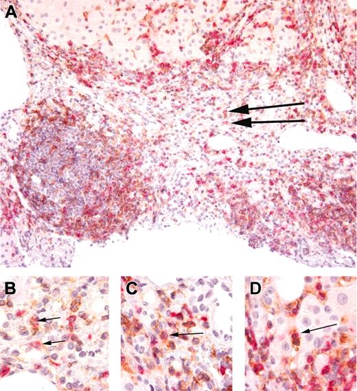 Figure 5. Intrahepatic CD4+CD8+ cells in HCV infection. (A) Liver histology (original magnification × 200) showing chronic hepatitis C, double stained for both CD4 (brown chromogen) and CD8 (red chromogen). T cells are clustered around the lymphoid aggregate and at the edges of the portal area where they are involved in interface hepatitis. The arrows indicate 2 CD4/CD8 double-stained cells. (B-D) High-magnification (original magnification × 1000) photomicrographs of double-stained cells in portal areas and hepatic sinuses. The arrows indicate CD4/CD8 double-stained cells.