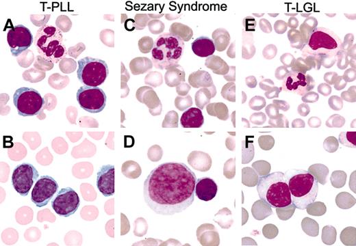 Figure 2. Typical and variant PB tumor cell morphology among mature T-cell leukemias. (A) T-PLL with typical prolymphocytoid morphology. (B) T-PLL with tumor cells having cerebriform nuclear morphology. (C) SS with typical cerebriform tumor morphology. (D) SS with large transformed nucleolated tumor cells (large cell, left) associated with a minor population of lower-grade tumor cells with cerebriform morphology (small cell, right). (E) T-LGL leukemia with monocytoid appearance. (F) T-LGL leukemia with high white blood cell count and variably nucleolated tumor cells. Original magnification, × 500 (Nikon Plan 50 0.5-0.85 oil lens).