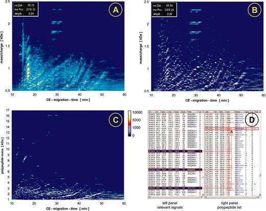 Figure 2. Raw data contour plots and data processing. The individual steps of the data processing are illustrated here, showing data obtained after screening urine from one patient. The initial raw data (A) are examined for signals that fit the criteria of “real polypeptide” signals, which are collected (B) and deposited in a peak list (D, left panel). Subsequently, a charge is assigned to each of these signals, conjugated peaks are combined as indicated by the red arrows, and as a result a spectrum based on mass and normalized migration time is obtained as graphically depicted in C. This spectrum contains the information on all peaks (a partial list is shown in D, right panel), including time, mass, intensity and signal-to-noise ratio.
