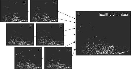 Figure 3. Generation of patterns for groups of test persons. The screening of samples obtained from different healthy individuals yielded the generation of several hundreds of plots to date. The storage of all data within the database allows the comparison of the individual data and the compilation of the data into a general pattern significant for health (shown here). This allows screening for common molecules excreted in different individuals and can also be applied toward the data exploitation of patients with different diseases or even different stages of disease. In analogy to the generation of the control pattern, pattern for patients undergoing HSCT were generated.