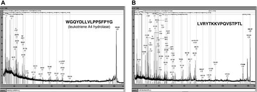 Figure 7. Sequence of 2 discriminating polypeptides indicative for GVHD. Two prominently excreted polypeptides for GVHD (Table 3) were sequenced yielding peptides shown above as MALDI-MS-MS spectra as well as sequence. Searching of the databases revealed one 1.85 kDa/34 minutes polypeptide from leukotriene A4 hydrolase (A) and one 1.83 kDa/33.2 minutes polypeptide from serum albumin (B).