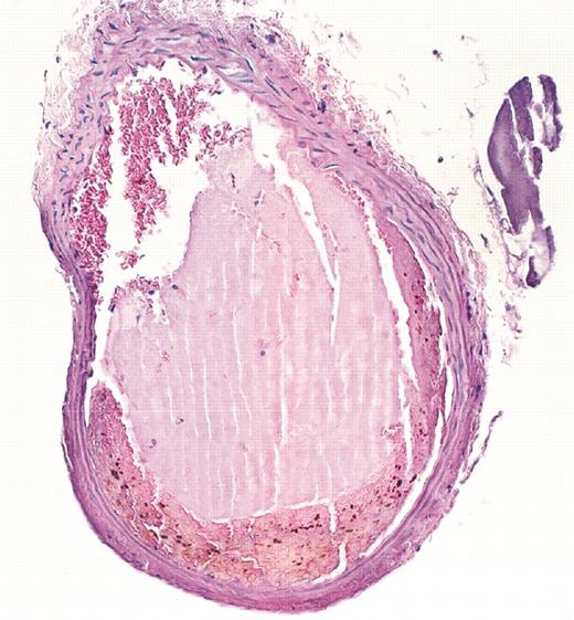 Arterial occlusion after FeCl3-induced injury. See the complete figure in the article beginning on page 415.