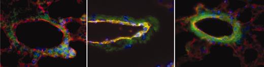 Figure 2. Examples of pulmonary vessels from a sickle mouse. To obtain these images, TF (green), CD31 (red), and nuclei (blue) are overlaid to obtain a merged image in which TF-positive endothelial cells are yellow-orange in color. The vein in the left panel is negative for endothelial TF, whereas the ones in middle and right panels are positive. Note that in middle and, particularly, right images, nonendothelial TF staining has increased prominence as well. Original magnification, × 600.