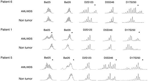 Figure 4. Microsatellite instability in AML/MDS from recipients of organ transplants. Examples of MSI in AML/MDS (patients 1, 5, and 6). DNA recovered from paraffin blocks of bone marrow (tumor) or explanted tissue (normal) was amplified at the indicated microsatellites. *Unstable loci.