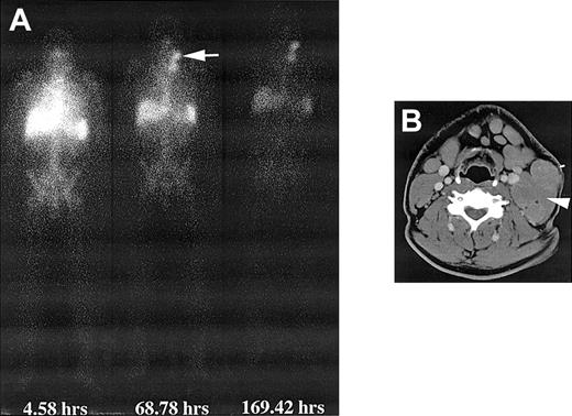 Figure 2. Whole-body and CT images after infusion of 131I-labeled chimeric 81C6 mAb. (A) Whole-body images of a patient obtained at different time points after infusion of 370 MBq 131I-labeled chimeric 81C6 mAb. Note the prolonged uptake in the nodal disease in the neck. (B) CT scan depicting the nodal disease (arrow) that accumulated the radiolabeled antibody. A biopsy sample was obtained from this node 44 hours after dosimetric infusion of 370 MBq, and the measured activity concentration was 70 kBq/g.