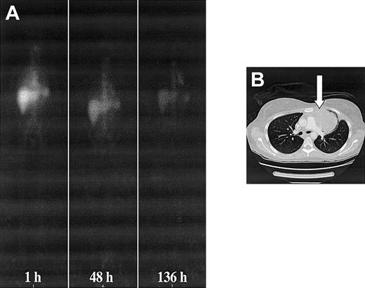 Figure 3. Whole-body and CT images of patient no. 2. (A) Serial anterior whole-body images of patient no. 2 showing increased accumulation of 131I-labeled 81C6 mAb in a large mediastinal lesion. (B) CT image showing the location of the lesion affecting the left lung. A biopsy sample was obtained from this node 17 hours after a dosimetric infusion of 370 MBq. The measured activity concentration was 37 kBq g-1. A supplemental video is available at the Blood website; see the Supplemental Video link at the top of the online article.