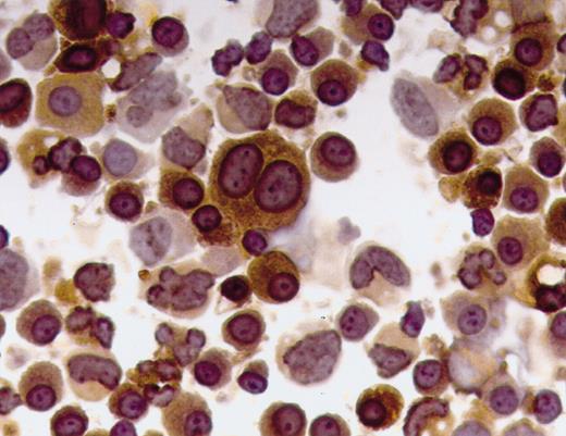 Immunocytochemical analyses of plasma cells from the patient with NSM and chemical characterization of the nonsecreted κ light chains. See the complete figure in the article beginning on page 829.