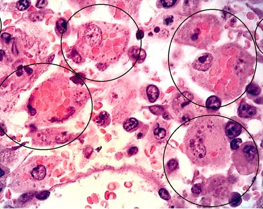 LCMV-infected pfp–/– mice display histopathologic features of HLH. See the complete figure in the article beginning on page 735.