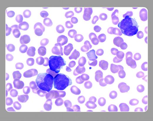 John J. Lazarchick, Department of Pathology, Mobile Infirmary, and John Lazarchick, Department of Pathology, Medical University of South Carolina