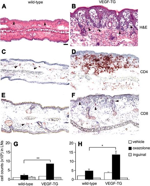 Figure 2. Transgenic overexpression of VEGF-A induces a psoriasis-like phenotype after experimental induction of inflammation. One month after challenge, the ears of wild-type mice showed normal histoarchitecture and no apparent sign of inflammation (A). In VEGF-A–overexpressing mice, the challenged skin showed epidermal hyperplasia, fingerlike communicating epidermal protrusions into the dermis and a dense inflammatory infiltrate (B). A few CD4+ and CD8+ T cells (arrowheads) were scattered throughout the dermis of wild-type mice (C and E) one month after challenge whereas in VEGF-A transgenic mice, dense CD4+ infiltrates were found in the dermis (D) and CD8+ cells predominantly in the epidermis (F). Stains: (A-B) hematoxylin and eosin, (C-D) CD4, (E-F) CD8. Scale bar: 100 μm. At 24 hours after challenge, lymph nodes draining the oxazolone-challenged ears of VEGF-A transgenic mice contained 3.5 times more lymphocytes (G), as compared with wild-type mice. After 7 days, the number of lymphocytes remained highly elevated in the lymph nodes draining oxazolone-challenged sites in VEGF-A transgenic mice (H). No major differences in the number of activated T-lymphocytes were found in inguinal lymph nodes. Data are expressed as mean plus or minus SEM (n = 3 per condition and time point). *P < .05; **P < .01.