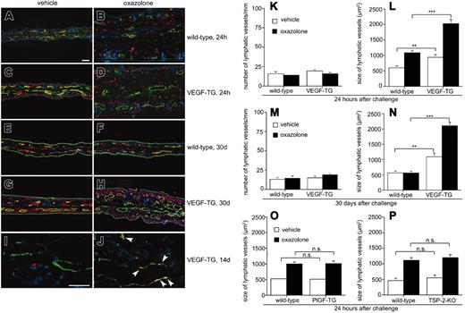 Figure 4. Lymphatic vessel enlargement and proliferation in the ear skin of VEGF-A transgenic mice. In VEGF-A transgenic mice, the number of small, tortuous, CD31+(red)/LYVE-1– blood vessels was increased in the superficial dermis adjacent to the site of transgenic VEGF-A overexpression (C-D, G-H), as compared with wild-type mice (A-B, E-F). Lymphatic vessels (LYVE-1+, green) were larger in the ear skin of VEGF-A–overexpressing mice (C, G) than in wild-type mice (A, E) under noninflamed conditions. At 24 hours after elicitation of DTH reactions, lymphatic vessels were dramatically more enlarged in transgenic mice (D) compared with wild-type littermates (B). By 30 days later, lymphatic vessels in challenged ears had returned to normal size in wild-type mice (F), but not in VEGF-A transgenic mice, in which lymphatic vessels remained enlarged (H). Scale bar: 100 μm. Double stains for the lymphatic marker podoplanin (green) and the proliferation marker Ki67 (red) demonstrated active lymphatic endothelial cell proliferation (arrowheads) in the enlarged lymphatics of inflamed ears (14 days) of VEGF-A transgenic mice (J) but not in vehicle-treated ears (I). Scale bar: 50 μm. Computer-assisted morphometric analysis revealed comparable numbers of lymphatic vessels per millimeter ear length in VEGF-A transgenic (TG) and wild-type mice, either treated with vehicle (□) or after induction of the DTH (▪) (K). In contrast, the size of lymphatic vessels was significantly increased in untreated skin of VEGF-A transgenic mice with a further pronounced increase at 24 hours after challenge (L). After 30 days, the number of lymphatic vessels per millimeter ear length varied only insignificantly between transgenic and wild-type mice (M). However, lymphatic vessels remained enlarged in transgenic mice, but had returned to their original size in wild-type mice (N). Data are expressed as mean plus or minus SEM (n = 3 per genotype and time point). **P < .01, ***P < .001. In contrast, the lymphatic vessel size in the inflamed ear skin of PlGF transgenic mice (O) and of TSP-2–deficient mice (P), which are also characterized by enhanced inflammation, angiogenesis, and edema formation, was comparable to wild-type mice at 24 hours after induction of DTH reactions (n = 3 per genotype and time point).