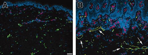 Figure 6. Lymphatic vessel enlargement in patients with psoriasis. (A) Clinically uninvolved skin from patients with psoriasis showed normal patterns of blood (red; CD31) and lymphatic (green; LYVE-1) vessels. (B) Psoriatic skin was characterized by multiple enlarged blood vessels in the upper dermis adjacent to the thickened epidermis and by highly enlarged lymphatic vessels (arrows). Representative pictures from the lower back are shown. Scale bar: 100 μm.