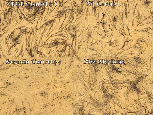 Figure 1. Human in vitro angiogenesis assay. Photomicrographs demonstrate tubule formation in the human in vitro angiogenesis assay. (top left panel) Stimulation of tubule formation with the addition of VEGF. (bottom left panel) Inhibition of tubule formation with the addition of suramin. (top right panel) No treatment (NT) control without added cytokines or inhibitors. (bottom right panel) Stimulation of tubule formation by plasma of a myeloma patient. Pictures obtained at 12.5 × 0.04 (magnification/aperture).